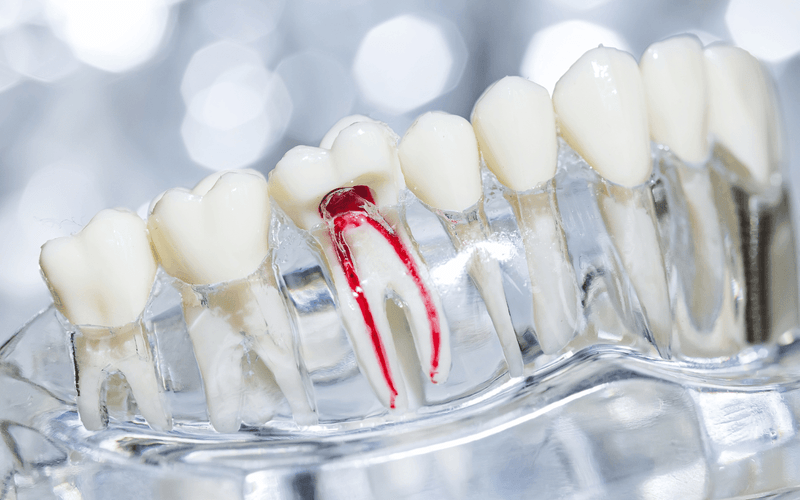 علاج وإعادة علاج قناة الجذر