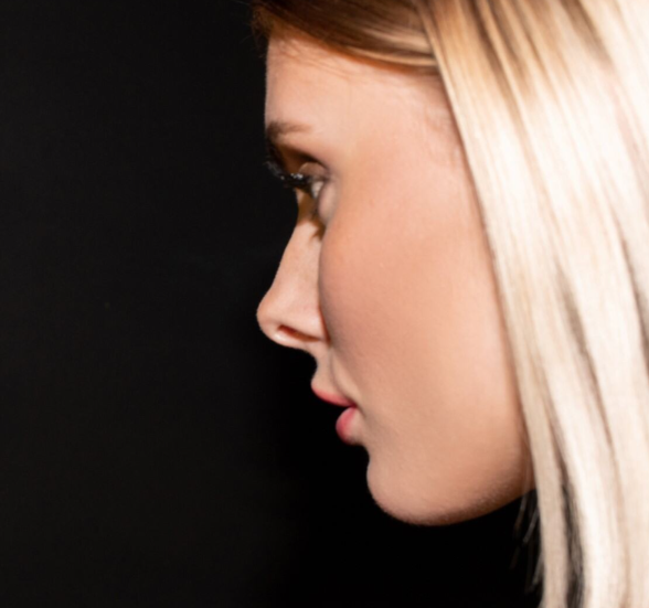 Rhinoplasty